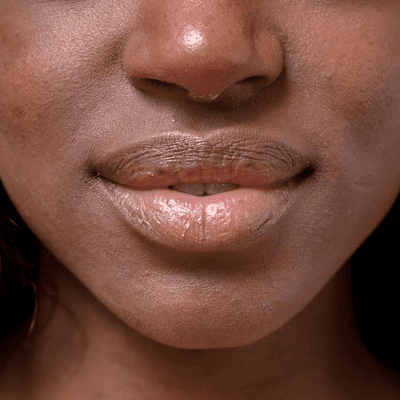 5 Natural Remedies You Need To Try For Chapped Lips