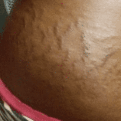 How To Naturally Make Your Stretch Marks Fade Away